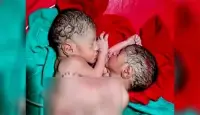 Conjoined-head twins sent to Dhaka from Patuakhali
